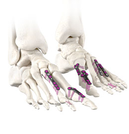Forefoot-2019