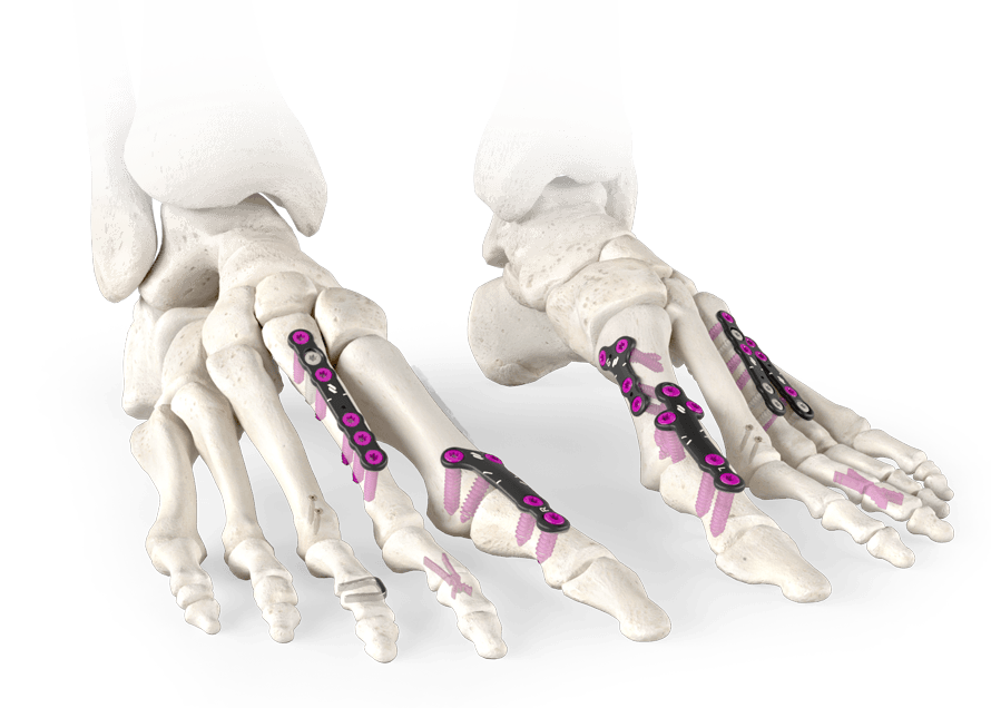 Forefoot-Catagory-Banner-compressor