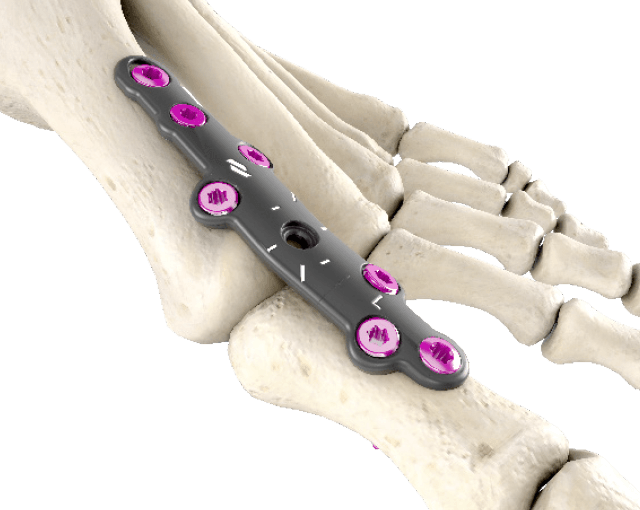 Long Revision Plate-in-bone