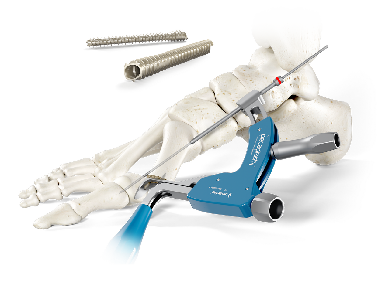 rsz_1pecaplasty-web-header-image